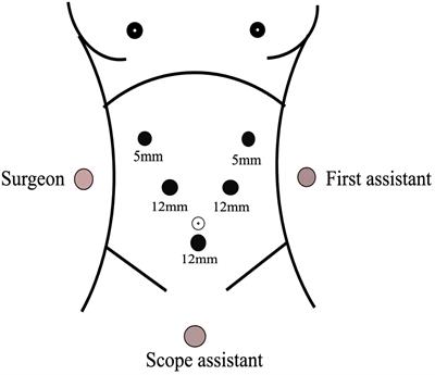 Analysis of the clinical efficacy of laparoscopic middle pancreatectomy in the treatment of benign or low-grade malignant tumors of the pancreas